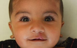 Free Cleft Lip/Palate Surgeries